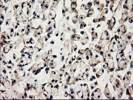 IHC of paraffin-embedded Adenocarcinoma of Human colon tissue using anti-ACOT12 mouse monoclonal antibody.