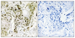 IHC of paraffin-embedded human breast carcinoma tissue, using BCOR Antibody. The picture on the right is treated with the synthesized peptide.