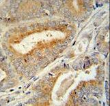 BCORL1 antibody immunohistochemistry of formalin-fixed and paraffin-embedded human prostate carcinoma followed by peroxidase-conjugated secondary antibody and DAB staining.