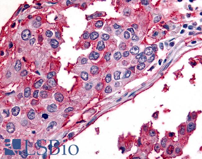 Anti-BEST2 / Bestrophin-2 antibody IHC of human Lung, Non-Small Cell Carcinoma. Immunohistochemistry of formalin-fixed, paraffin-embedded tissue after heat-induced antigen retrieval.