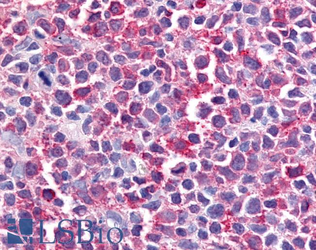Anti-BEST2 / Bestrophin-2 antibody IHC of human Lymph Node, Non-Hodgkins Lymphoma. Immunohistochemistry of formalin-fixed, paraffin-embedded tissue after heat-induced antigen retrieval.