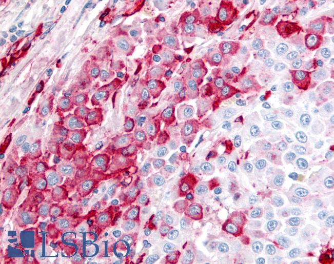 Anti-BEST4 antibody IHC of human Skin, Melanoma. Immunohistochemistry of formalin-fixed, paraffin-embedded tissue after heat-induced antigen retrieval.