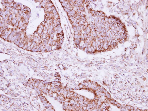 IHC of paraffin-embedded Colon ca, using ACOT9 antibody at 1:250 dilution.