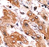 Formalin-fixed and paraffin-embedded human cancer tissue reacted with the primary antibody, which was peroxidase-conjugated to the secondary antibody, followed by AEC staining. This data demonstrates the use of this antibody for immunohistochemistry; clinical relevance has not been evaluated. BC = breast carcinoma; HC = hepatocarcinoma.