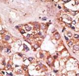 Formalin-fixed and paraffin-embedded human cancer tissue reacted with the primary antibody, which was peroxidase-conjugated to the secondary antibody, followed by AEC staining. This data demonstrates the use of this antibody for immunohistochemistry; clinical relevance has not been evaluated. BC = breast carcinoma; HC = hepatocarcinoma.