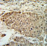 Formalin-fixed and paraffin-embedded human hepatocarcinoma reacted with BIN3 Antibody , which was peroxidase-conjugated to the secondary antibody, followed by DAB staining. This data demonstrates the use of this antibody for immunohistochemistry; clinical relevance has not been evaluated.