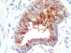 cIAP2/HIAD1 Antibody - IHC of human adenocarcinoma cells and adjacent glands using anti-cIAP2.