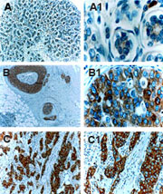 IHC of cIAP2 in paraffin-embedded formalin-fixed human mammary gland (female breast) using LS-C148260 at 1:2000. A, normal breast tissue. B, ductal carcinoma in situ (DCIS). C. invasive neoplasia. cIAP2 expressed increased successively with tumor progression. Hematoxylin-Eosin counterstain.