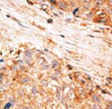 Formalin-fixed and paraffin-embedded human cancer tissue reacted with the primary antibody, which was peroxidase-conjugated to the secondary antibody, followed by AEC staining. This data demonstrates the use of this antibody for immunohistochemistry; clinical relevance has not been evaluated. BC = breast carcinoma; HC = hepatocarcinoma.
