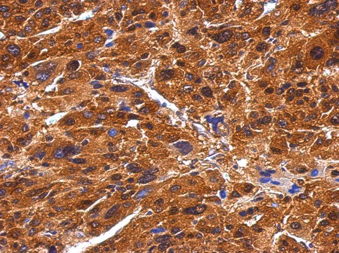 IHC of paraffin-embedded Hepatoma using BIVM antibody at 1:500 dilution.
