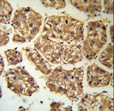 BLNK Antibody (RB18883) IHC of formalin-fixed and paraffin-embedded human hepatocarcinoma followed by peroxidase-conjugated secondary antibody and DAB staining.