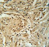 BLOC1S2 Antibody immunohistochemistry of formalin-fixed and paraffin-embedded human cervix carcinoma followed by peroxidase-conjugated secondary antibody and DAB staining.
