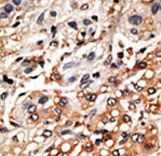 Formalin-fixed and paraffin-embedded human cancer tissue reacted with the primary antibody, which was peroxidase-conjugated to the secondary antibody, followed by DAB staining. This data demonstrates the use of this antibody for immunohistochemistry; clinical relevance has not been evaluated. BC = breast carcinoma; HC = hepatocarcinoma.