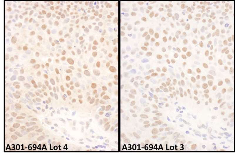 Detection of Human BMI1 by Immunohistochemistry. Sample: FFPE section of human lung carcinoma. Antibody: Affinity purified rabbit anti-BMI1 ( Lot4 - left and Lot3 - right) used at a dilution of 1:1000 (1 ug/ml). Detection: DAB.
