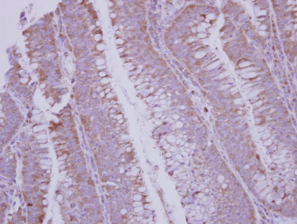 IHC of paraffin-embedded Colon ca using BMP10 antibody at 1:250 dilution.