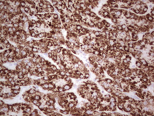 IHC of paraffin-embedded Carcinoma of Human liver tissue using anti-ABAT mouse monoclonal antibody. (Heat-induced epitope retrieval by 1 mM EDTA in 10mM Tris, pH8.5, 120°C for 3min).