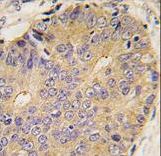Formalin-fixed and paraffin-embedded human prostate carcinoma tissue reacted with BMP15 antibody , which was peroxidase-conjugated to the secondary antibody, followed by DAB staining. This data demonstrates the use of this antibody for immunohistochemistry; clinical relevance has not been evaluated.