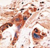 Formalin-fixed and paraffin-embedded human cancer tissue reacted with the primary antibody, which was peroxidase-conjugated to the secondary antibody, followed by AEC staining. This data demonstrates the use of this antibody for immunohistochemistry; clinical relevance has not been evaluated. BC = breast carcinoma; HC = hepatocarcinoma.