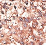 Formalin-fixed and paraffin-embedded human cancer tissue reacted with the primary antibody, which was peroxidase-conjugated to the secondary antibody, followed by AEC staining. This data demonstrates the use of this antibody for immunohistochemistry; clinical relevance has not been evaluated. BC = breast carcinoma; HC = hepatocarcinoma.
