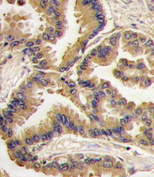 Formalin-fixed and paraffin-embedded human lung carcinoma tissue reacted with Bmp6 antibody , which was peroxidase-conjugated to the secondary antibody, followed by DAB staining. This data demonstrates the use of this antibody for immunohistochemistry; clinical relevance has not been evaluated.