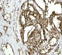 IHC of paraffin-embedded human prostatic adenocarcinoma tissue using anti-Prostatic Acid Phosphatase antibody.