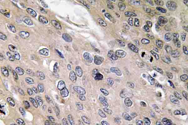 IHC of BMP-6 (A152) pAb in paraffin-embedded human lung carcinoma tissue.