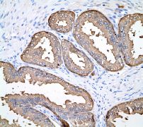 IHC of paraffin-embedded human prostatic tissue using anti-Prostatic Acid Phosphatase antibody.