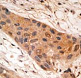 Formalin-fixed and paraffin-embedded human cancer tissue reacted with the primary antibody, which was peroxidase-conjugated to the secondary antibody, followed by AEC staining. This data demonstrates the use of this antibody for immunohistochemistry; clinical relevance has not been evaluated. BC = breast carcinoma; HC = hepatocarcinoma.