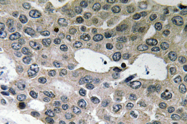 IHC of BNIP-2 (E122) pAb in paraffin-embedded human breast carcinoma tissue.