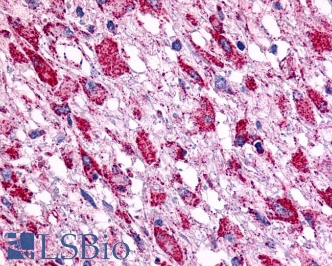 Anti-BOB / GPR15 antibody IHC of human Brain, Glioblastoma. Immunohistochemistry of formalin-fixed, paraffin-embedded tissue after heat-induced antigen retrieval.