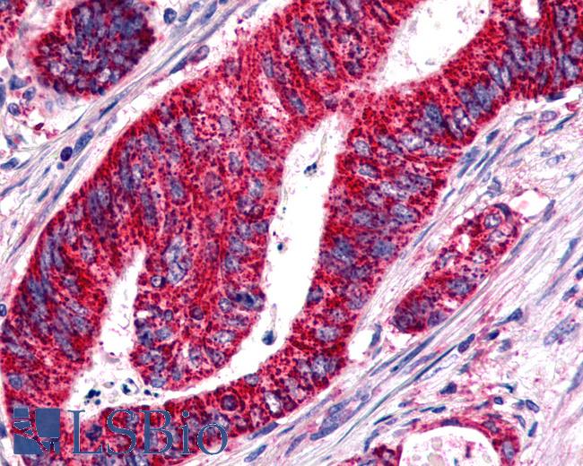 Anti-BOB / GPR15 antibody IHC of human Colon, Carcinoma. Immunohistochemistry of formalin-fixed, paraffin-embedded tissue after heat-induced antigen retrieval.