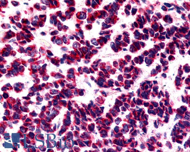 Anti-BOB / GPR15 antibody IHC of human Lung, Small Cell Carcinoma. Immunohistochemistry of formalin-fixed, paraffin-embedded tissue after heat-induced antigen retrieval.