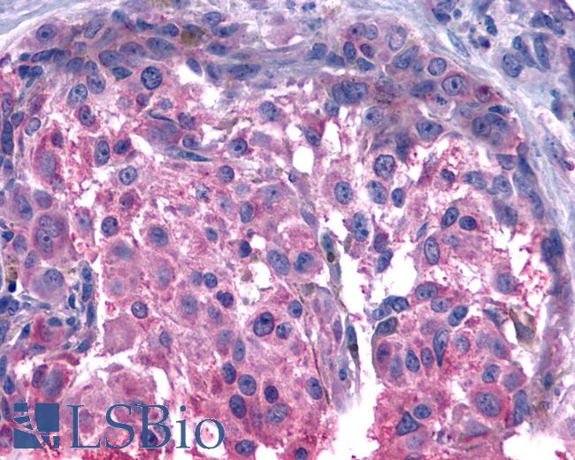 Anti-BOB / GPR15 antibody IHC of human Skin, Melanoma. Immunohistochemistry of formalin-fixed, paraffin-embedded tissue after heat-induced antigen retrieval.
