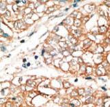 Formalin-fixed and paraffin-embedded human cancer tissue reacted with the primary antibody, which was peroxidase-conjugated to the secondary antibody, followed by DAB staining. This data demonstrates the use of this antibody for immunohistochemistry; clinical relevance has not been evaluated. BC = breast carcinoma; HC = hepatocarcinoma.