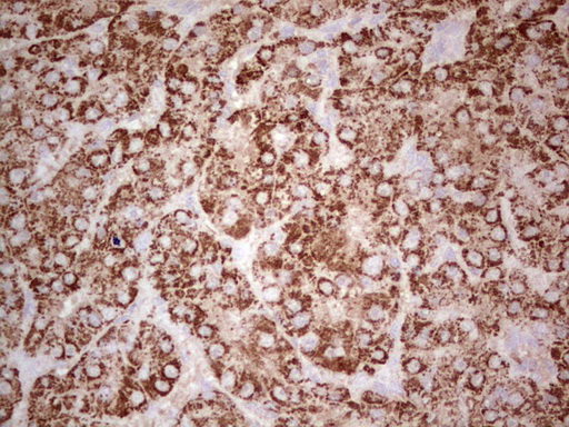 IHC of paraffin-embedded Carcinoma of Human liver tissue using anti-ABAT mouse monoclonal antibody. (Heat-induced epitope retrieval by 1 mM EDTA in 10mM Tris, pH8.5, 120°C for 3min).
