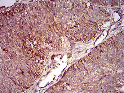 IHC of paraffin-embedded ovarian cancer tissues using mSplunc2 mouse monoclonal antibody with DAB staining.