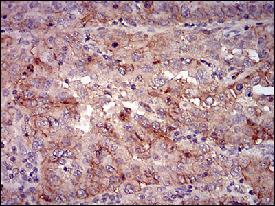 IHC of paraffin-embedded endometrial cancer tissues using mSplunc2 mouse monoclonal antibody with DAB staining.
