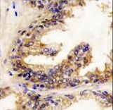 Formalin-fixed and paraffin-embedded human prostate carcinoma reacted with BRAF Antibody , which was peroxidase-conjugated to the secondary antibody, followed by DAB staining. This data demonstrates the use of this antibody for immunohistochemistry; clinical relevance has not been evaluated.