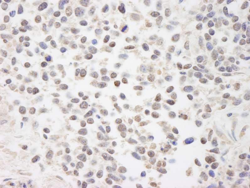 Detection of Human BAAT1 by Immunohistochemistry. Sample: FFPE section of human lung non-small cell cancer. Antibody: Affinity purified rabbit anti-BAAT1 used at a dilution of 1:250. Detection: DAB staining using anti-Rabbit IHC antibody at a dilution of 1:100.