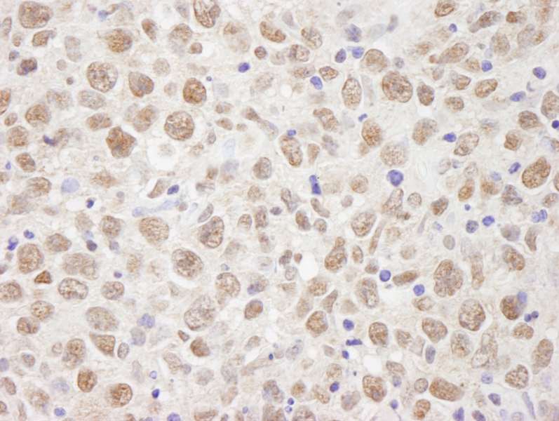 Detection of Human BAAT1 by Immunohistochemistry. Sample: FFPE section of human metastatic lymph node. Antibody: Affinity purified rabbit anti-BAAT1 used at a dilution of 1:250. Detection: DAB staining using anti-Rabbit IHC antibody at a dilution of 1:100.