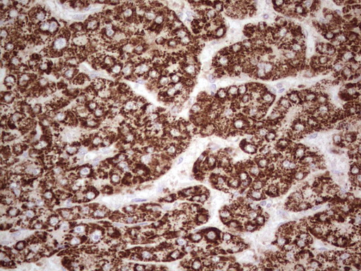 IHC of paraffin-embedded Carcinoma of Human liver tissue using anti-ABAT mouse monoclonal antibody. (Heat-induced epitope retrieval by 1 mM EDTA in 10mM Tris, pH8.5, 120°C for 3min).