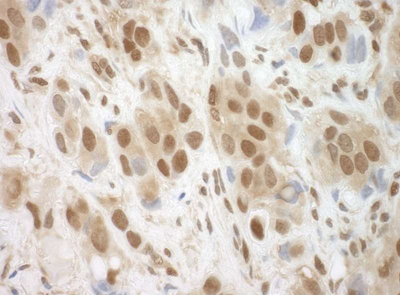 Detection of Human BRCC36 by Immunohistochemistry. Sample: FFPE section of human breast carcinoma. Antibody: Affinity purified rabbit anti-BRCC36 used at a dilution of 1:250.