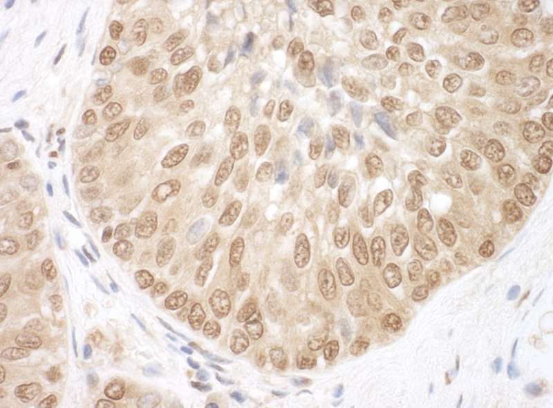 Detection of Human BRCC36 by Immunohistochemistry. Sample: FFPE section of human prostate carcinoma. Antibody: Affinity purified rabbit anti-BRCC36 used at a dilution of 1:1000 (1 ug/ml).