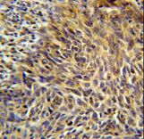 ANKRD32 Antibody immunohistochemistry of formalin-fixed and paraffin-embedded human cervix carcinoma followed by peroxidase-conjugated secondary antibody and DAB staining.