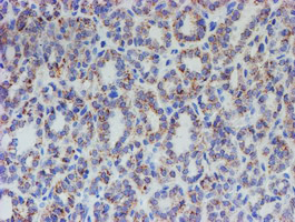 IHC of paraffin-embedded Carcinoma of Human thyroid tissue using anti-ACSF2 mouse monoclonal antibody.