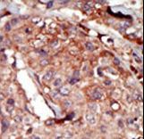 Formalin-fixed and paraffin-embedded human cancer tissue reacted with the primary antibody, which was peroxidase-conjugated to the secondary antibody, followed by AEC staining. This data demonstrates the use of this antibody for immunohistochemistry; clinical relevance has not been evaluated. BC = breast carcinoma; HC = hepatocarcinoma.