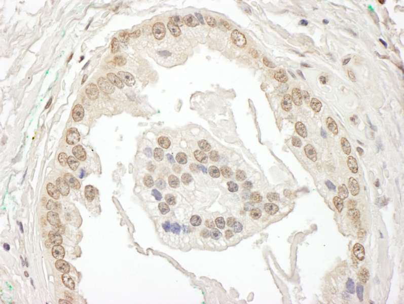 Detection of Human BRD7 by Immunohistochemistry. Sample: FFPE section of human prostate carcinoma. Antibody: Affinity purified rabbit anti-BRD7 used at a dilution of 1:1000 (1 ug/ml).