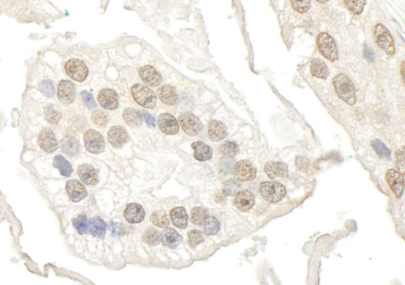 Detection of Human BRD7 by Immunohistochemistry. Sample: FFPE section of human prostate carcinoma. Antibody: Affinity purified rabbit anti-BRD7 used at a dilution of 1:250.