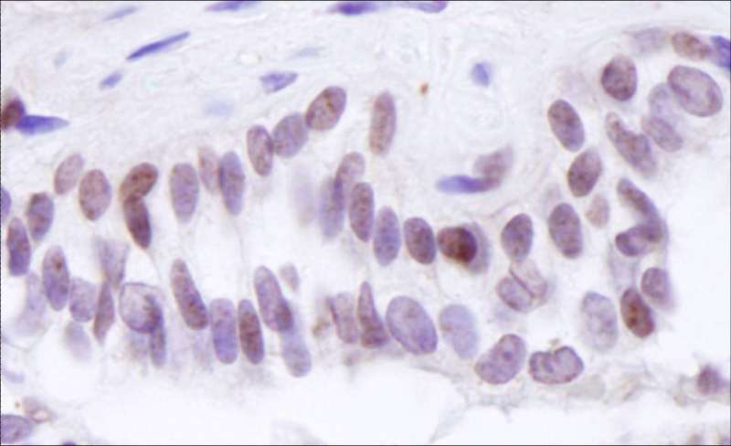 Detection of Human BRD8 by Immunohistochemistry. Sample: FFPE section of human prostate adenocarcinoma. Antibody: Affinity purified rabbit anti-BRD8 used at a dilution of 1:100. Detection: DAB.
