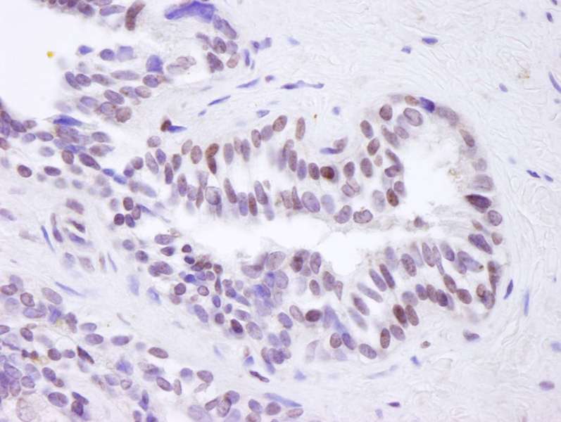 Detection of Human BRD8 by Immunohistochemistry. Sample: FFPE section of human prostate adenocarcinoma. Antibody: Affinity purified rabbit anti-BRD8 used at a dilution of 1:100. Detection: DAB.